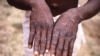 Sebuah gambar dari penyelidikan wabah cacar monyet di Republik Demokratik Kongo (DRC) sejak 1996 hingga 1997, menunjukkan tangan seorang pasien dengan ruam akibat cacar monyet. (CDC/Brian W.J. Mahy/Handout via REUTERS)