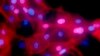Studies: Some Cancer Patients May Not Need Treatments after Surgery 