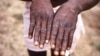 Les mains d'un patient atteint de variole du singe présentent l'éruption cutanée caractéristique au cours de sa phase de récupération. (CDC/ archives 1997)