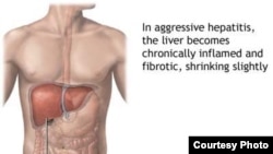 Hep B is the world’s most common liver infection. Photo courtesy of Adam.com