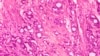 Radiation Drugs Hunt and Kill Cancer Cells