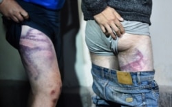 FILE - People detained during recent rallies of opposition supporters, who accuse Alexander Lukashenko of falsifying the polls in the presidential election, show their marks from beatings as they leave the Okrestina prison, in Minsk, Aug. 14, 2020.