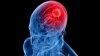 La osteoporosis debilita los huesos y provoca fracturas dolorosas principalmente de cadera, columna vertebral y muñeca.