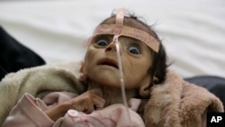 Infant Udai Faisal, who died from acute malnutrition a few months ago, is one of thousands of Yemeni children who are suffering from hunger as one of the most horrific consequence of the Yemeni conflict, blockade, and airstrikes by the Saudi-led coalition.