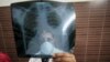 Researchers Streamline TB Testing to Speed Treatment